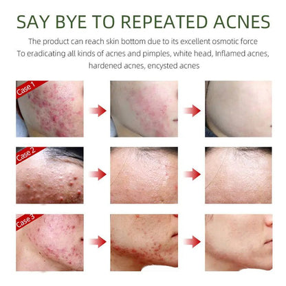 Before and after results of using BeautyStarts Anti Acne Removal Moisturizing Kit, demonstrating visible acne reduction and skin improvement.