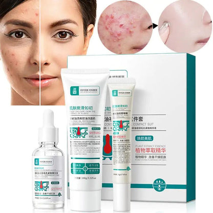 Before and after results of using BeautyStarts Anti Acne Removal Moisturizing Skin Care Kit, showing clear and smooth skin.