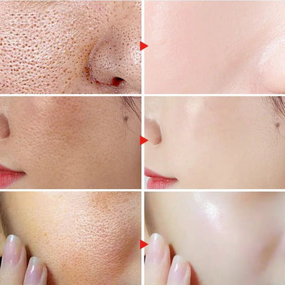 More before and after results of BeautyStarts Anti Acne Removal Kit, showcasing smoother, clearer skin with reduced acne.