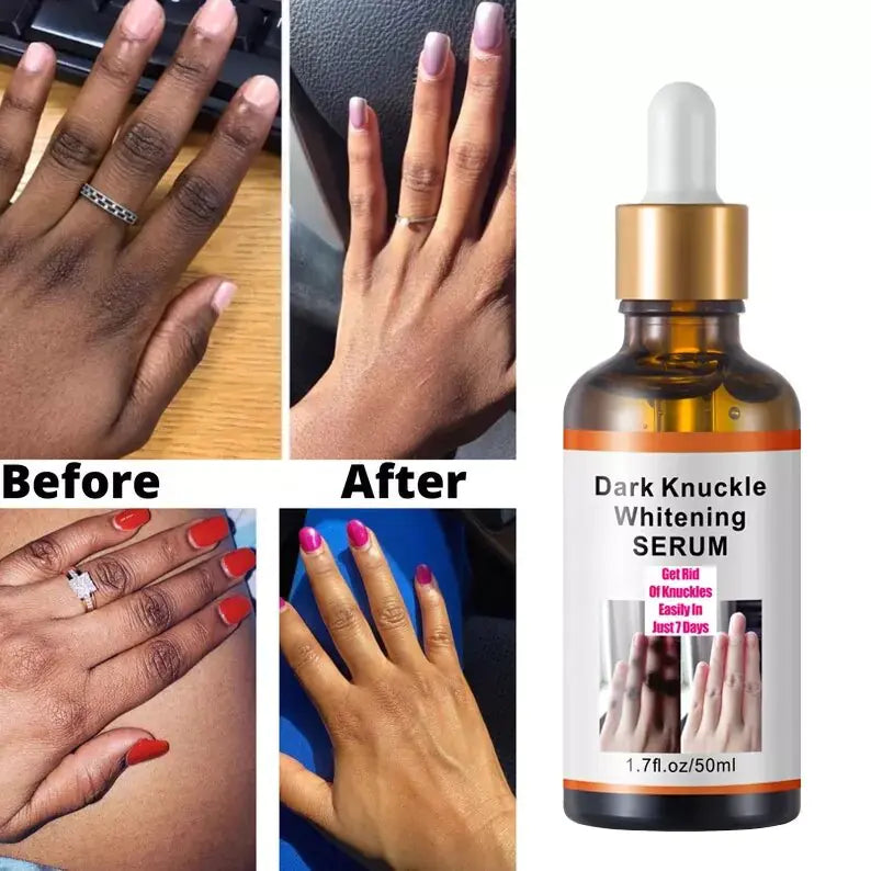 Intense Knuckle Whitening Serum – Before and After Effect for Dark Spots - BeautyStarts