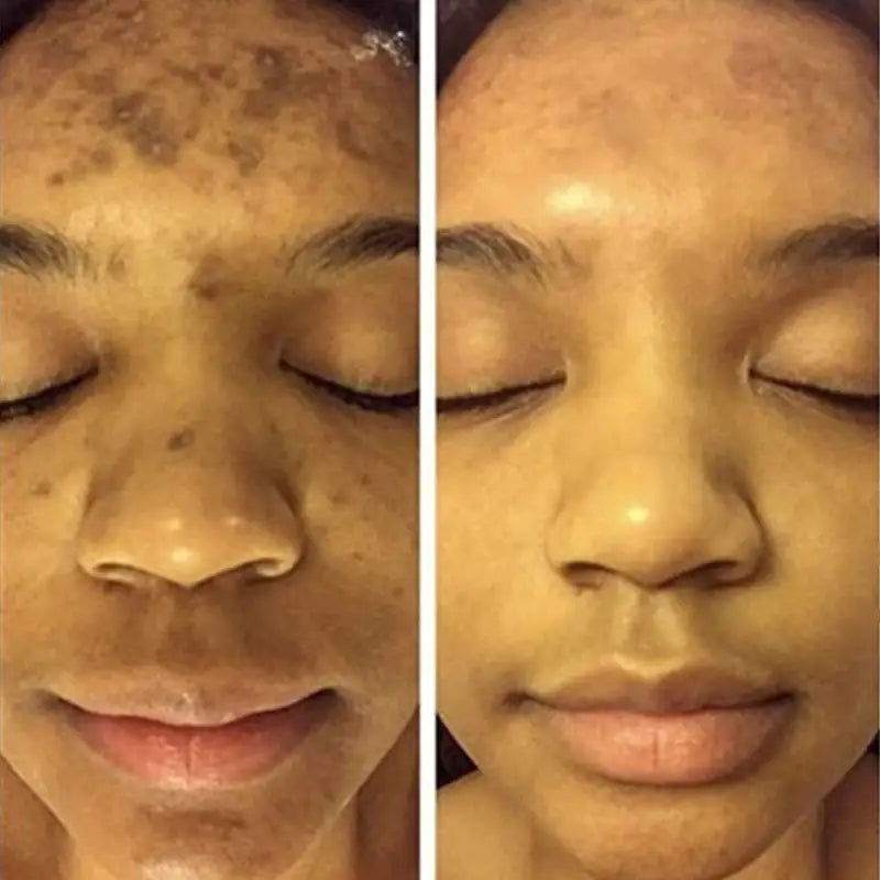 Before and After Using Turmeric Face Whitening Serum – Clearer, Brighter Skin with Regular Use – BeautyStarts